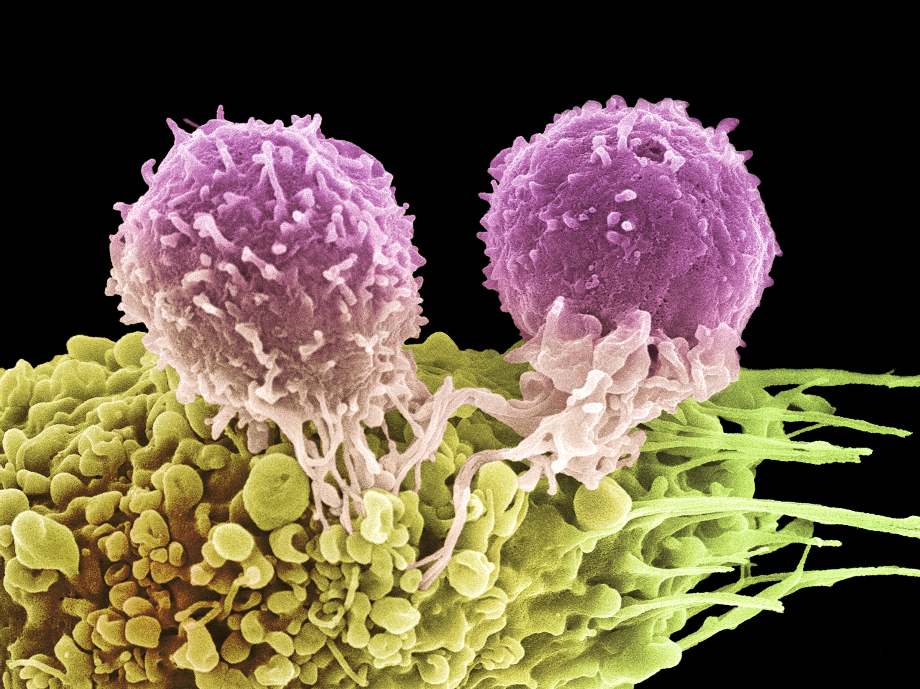 Immunotherapy: Can It Live Up To The Anti-Cancer Hype?