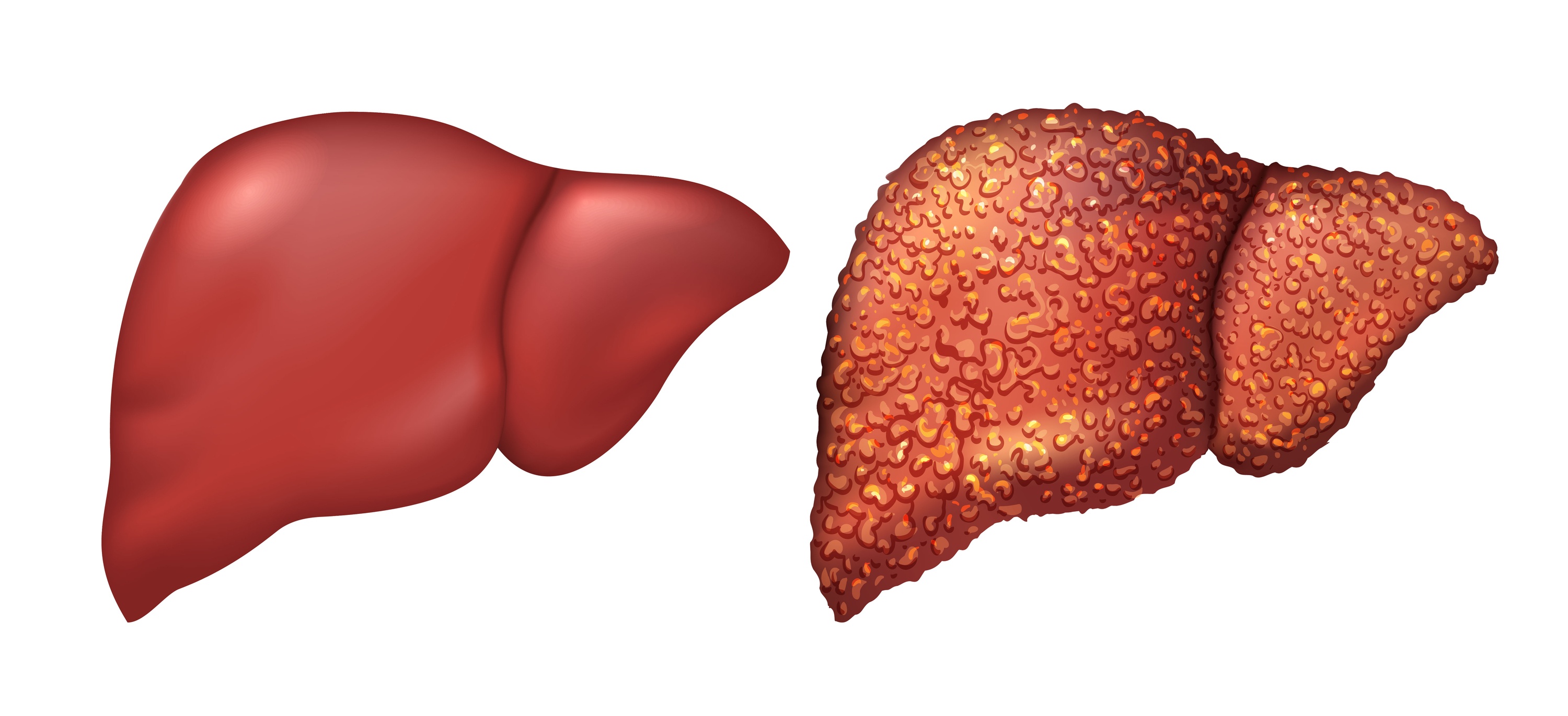 Liver of healthy person. Liver patients with hepatitis. Liver is