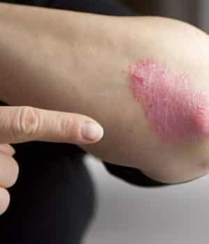 psoriasis